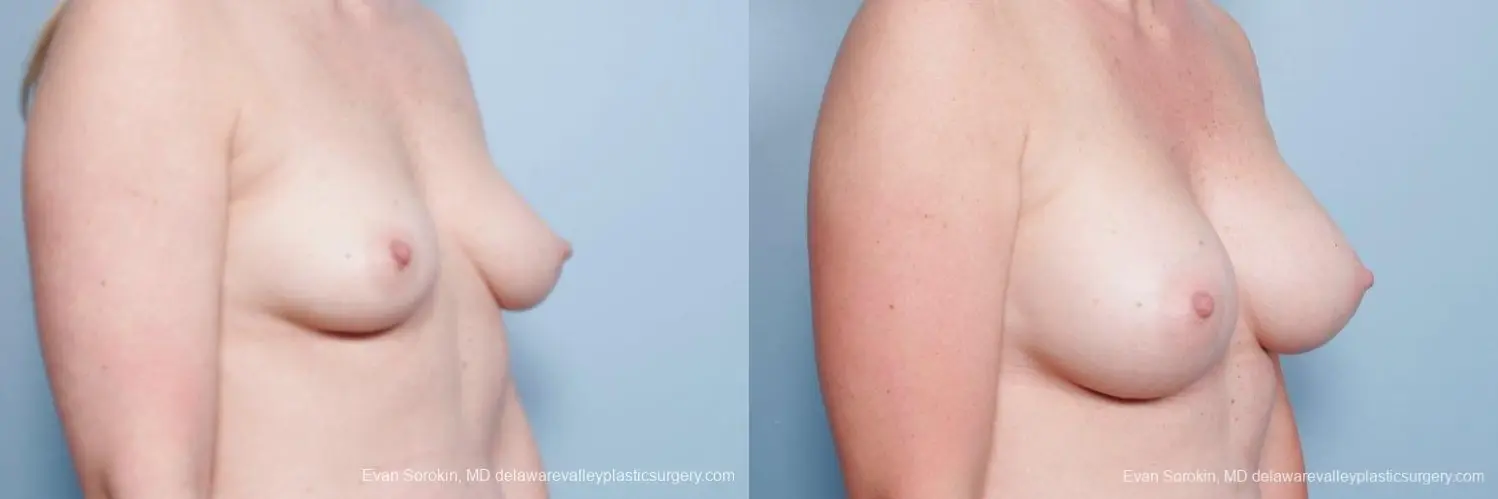 Philadelphia Breast Augmentation 8658 - Before and After 2