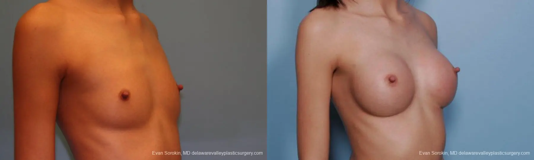 Philadelphia Breast Augmentation 9377 - Before and After 2