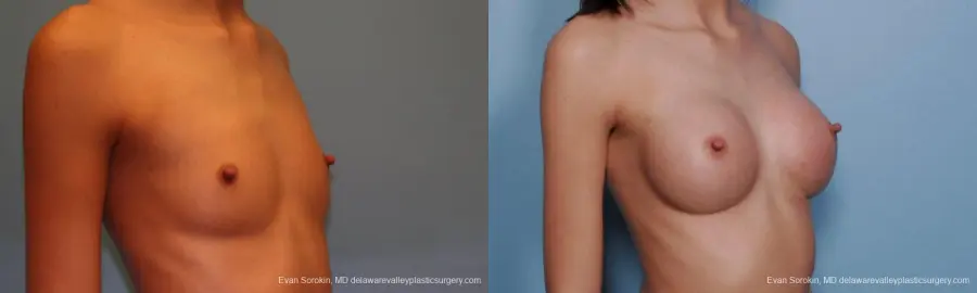Philadelphia Breast Augmentation 9377 - Before and After 2