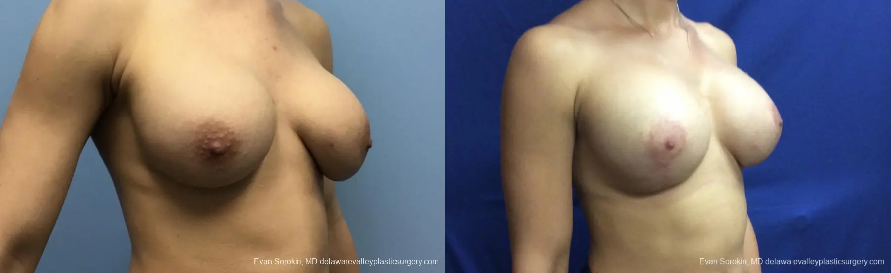 Breast Lift And Augmentation: Patient 42 - Before and After 2