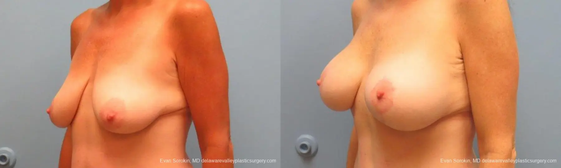 Philadelphia Breast Lift and Augmentation 9486 - Before and After 4