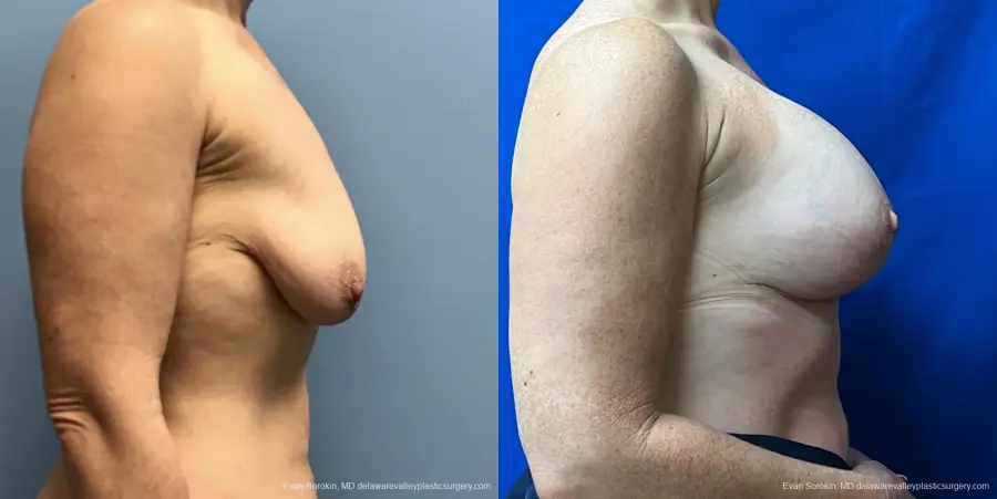 Breast Lift And Augmentation: Patient 47 - Before and After 3