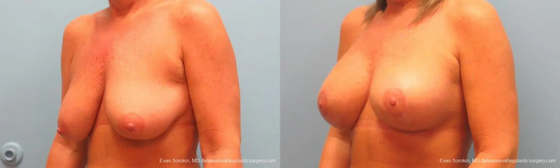 Philadelphia Breast Lift and Augmentation 9398 - Before and After 4