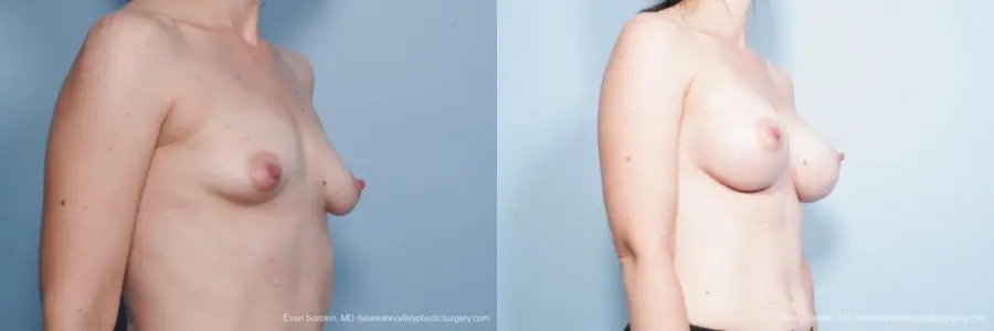 Philadelphia Breast Lift and Augmentation 8686 - Before and After 2