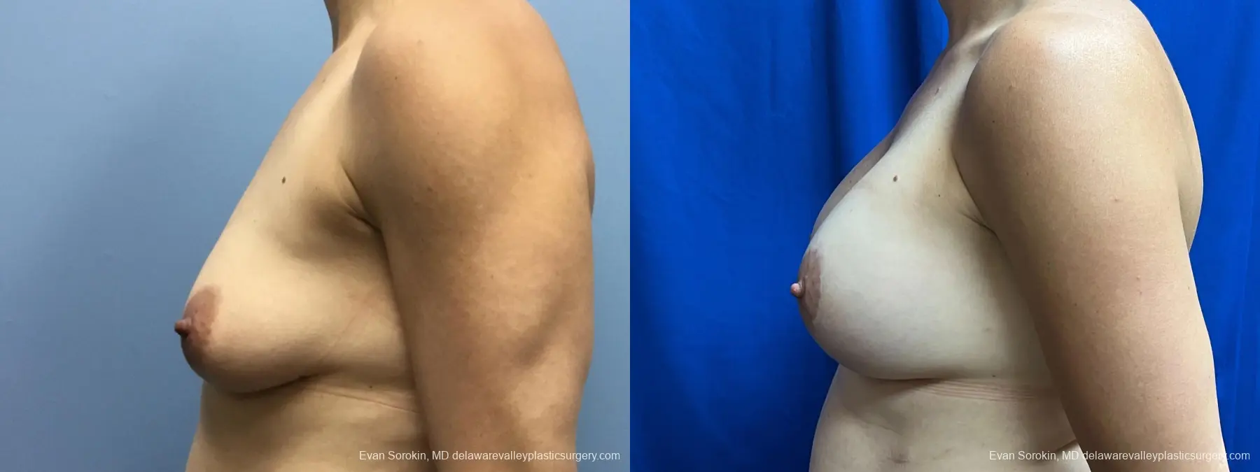 Breast Lift And Augmentation: Patient 48 - Before and After 4