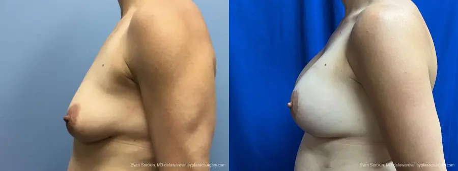 Breast Lift And Augmentation: Patient 48 - Before and After 5