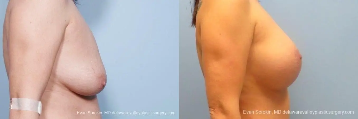 Philadelphia Breast Lift and Augmentation 8671 - Before and After 4