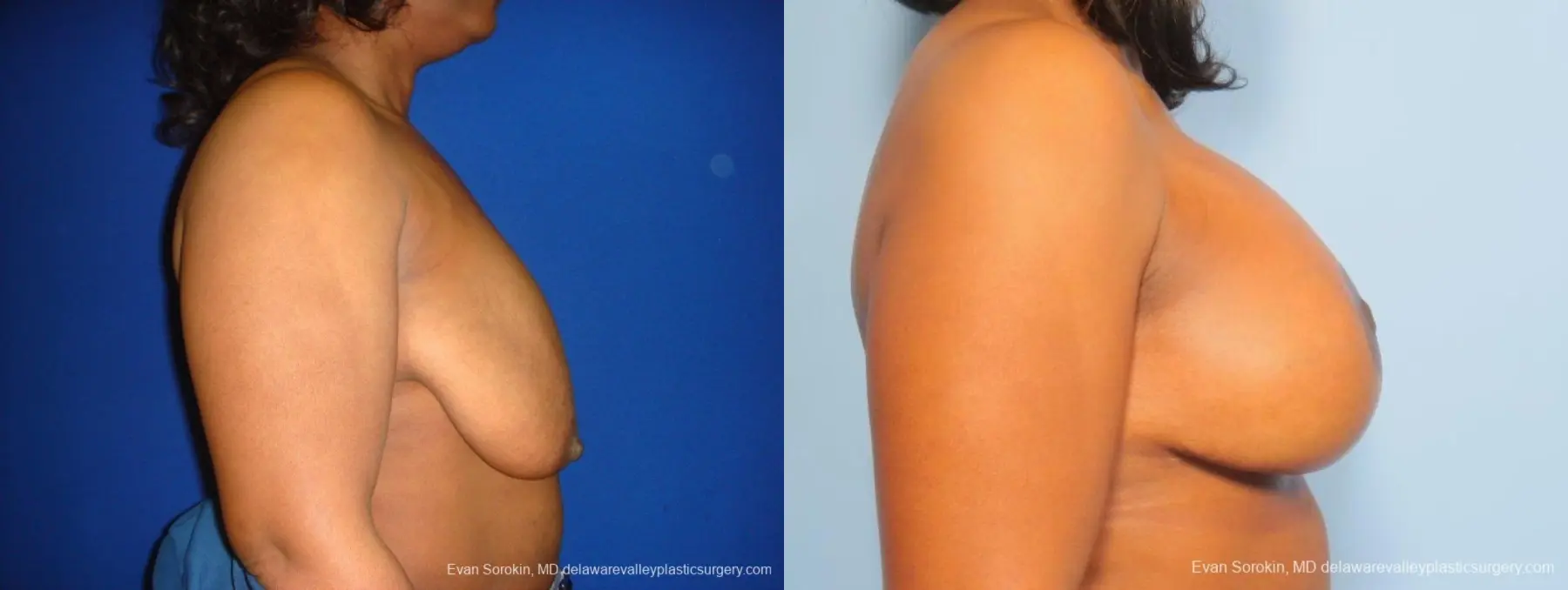 Philadelphia Breast Lift and Augmentation 8684 - Before and After 4