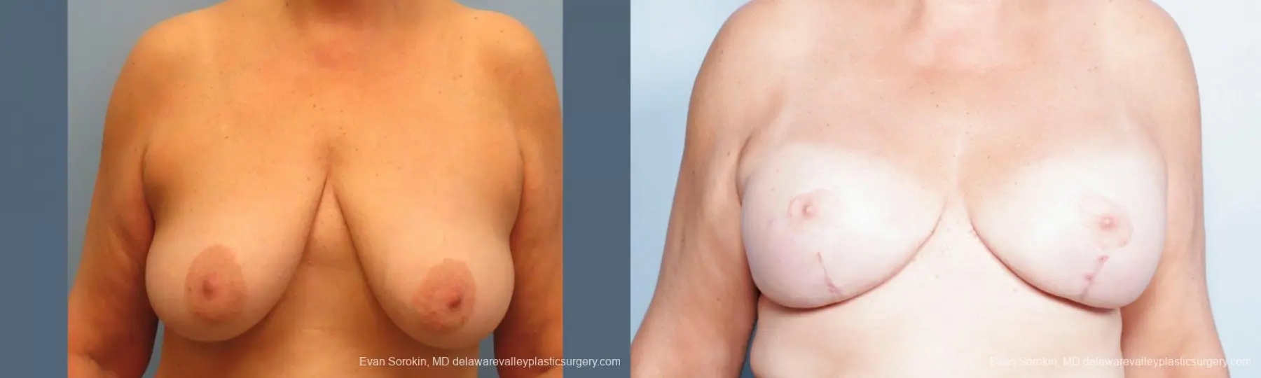 Philadelphia Breast Lift and Augmentation 9431 - Before and After 1