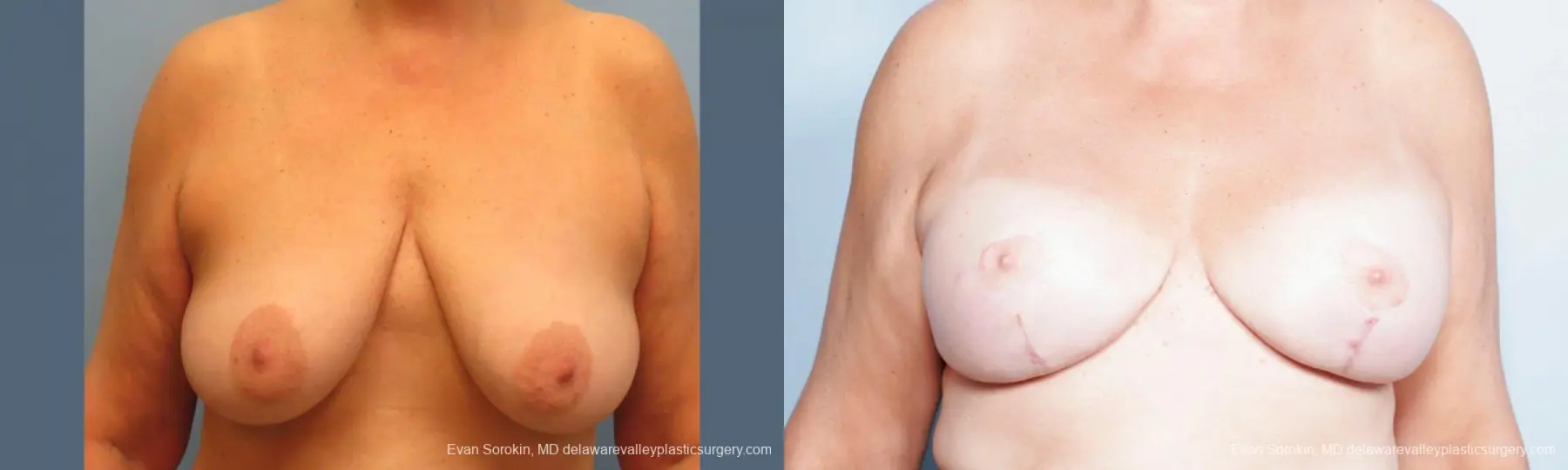 Philadelphia Breast Lift and Augmentation 9431 - Before and After