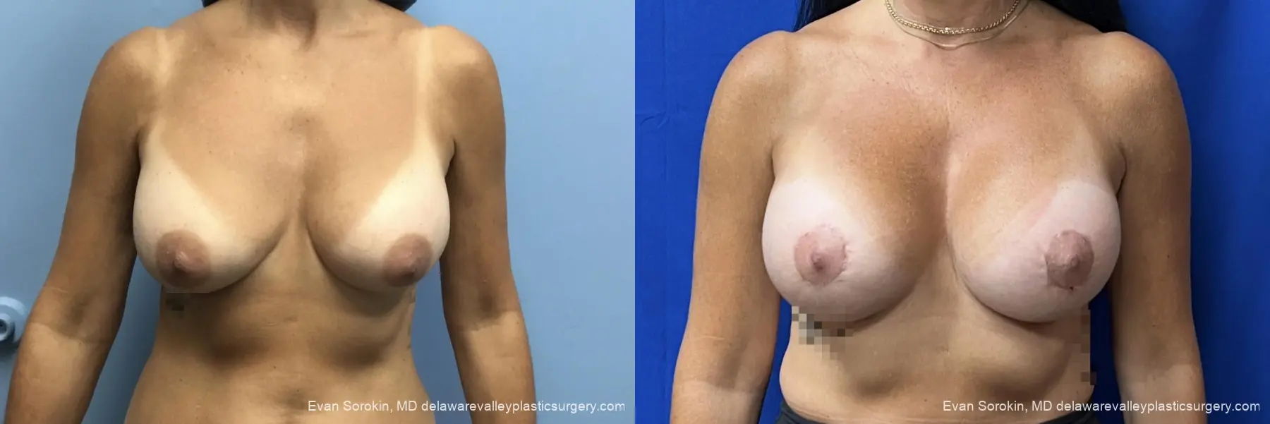 Breast-lift-and-augmentation-revision: Patient 1 - Before and After  