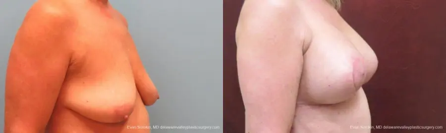 Philadelphia Breast Lift and Augmentation 9598 - Before and After 2