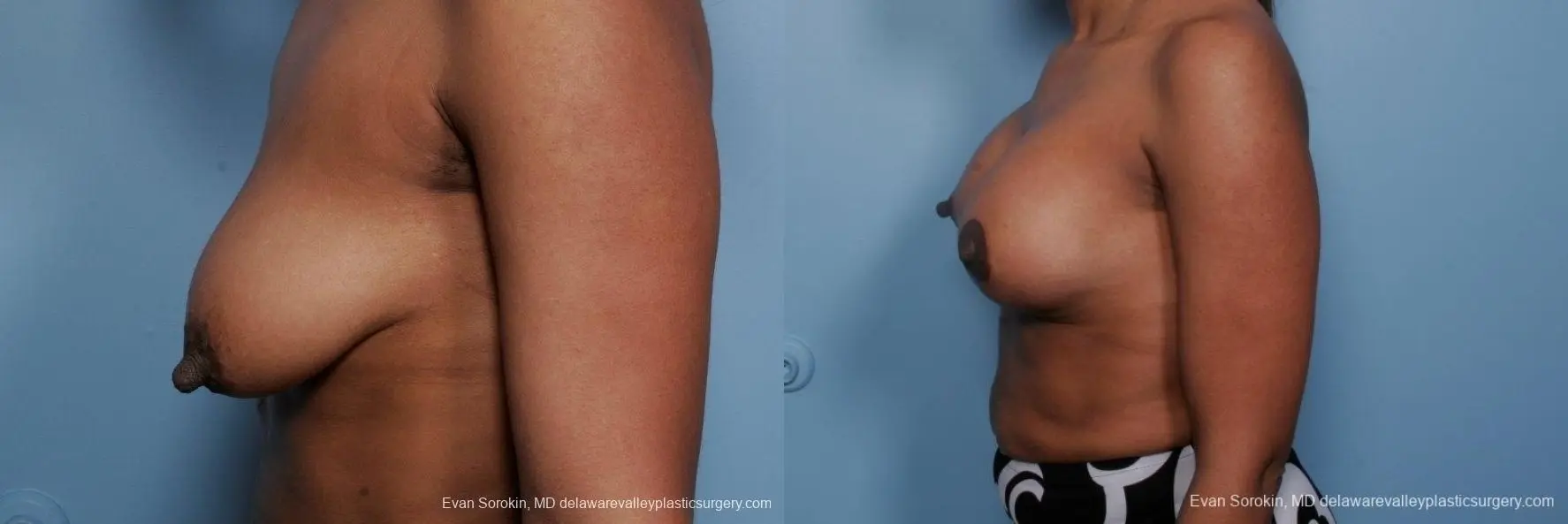Philadelphia Breast Lift and Augmentation 8689 - Before and After 5