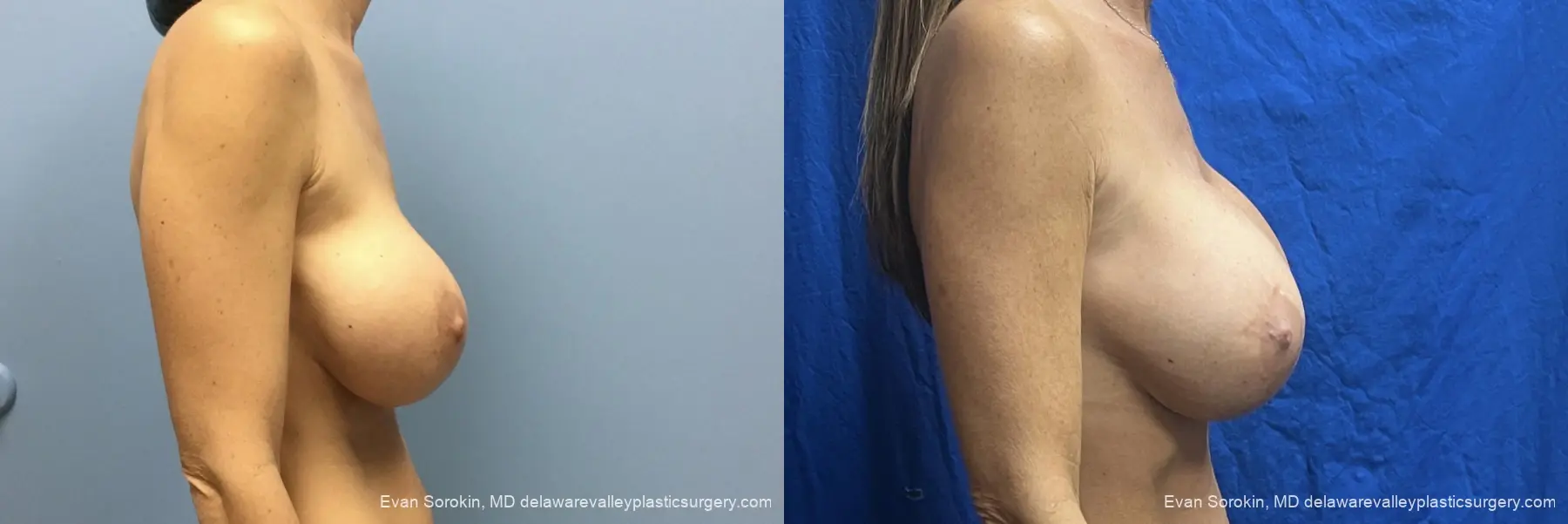 Breast Lift And Augmentation: Patient 58 - Before and After 3