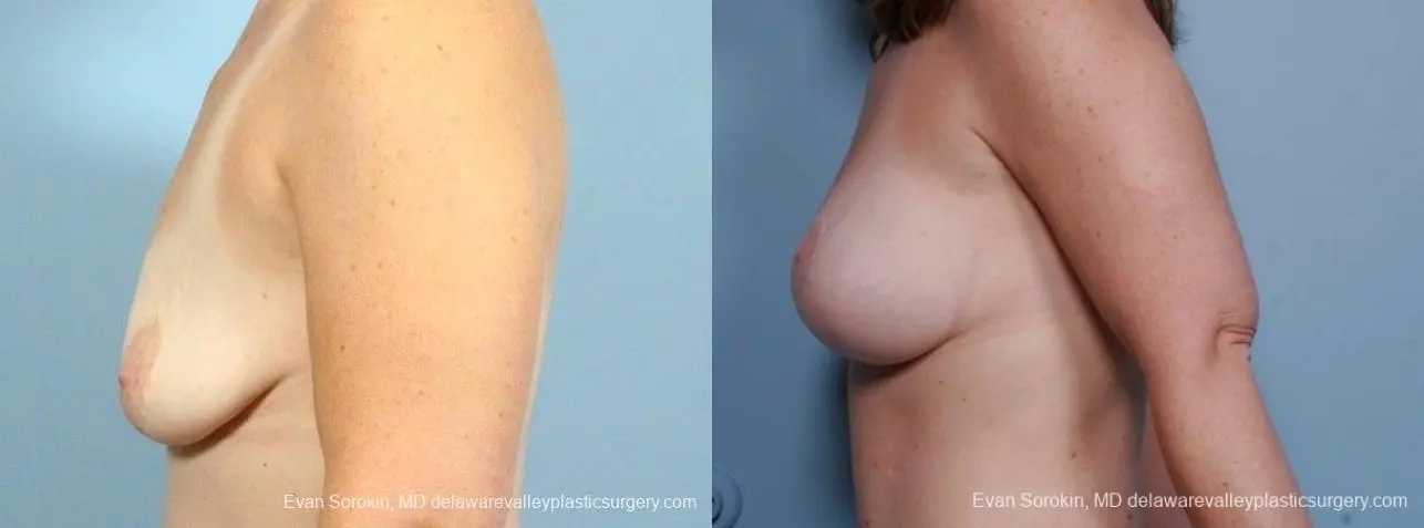 Philadelphia Breast Lift and Augmentation 8675 - Before and After 4