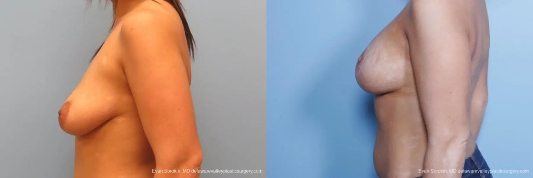 Philadelphia Breast Lift and Augmentation 8688 - Before and After 5
