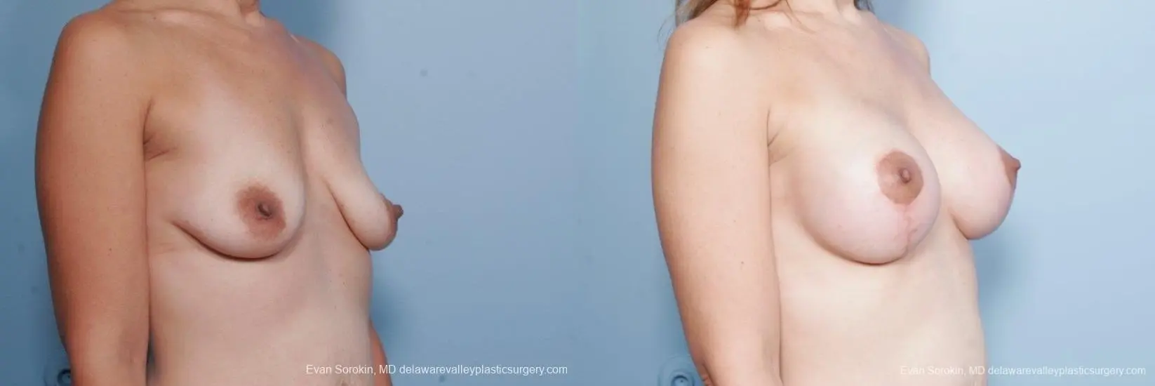 Philadelphia Breast Lift and Augmentation 8685 - Before and After 2
