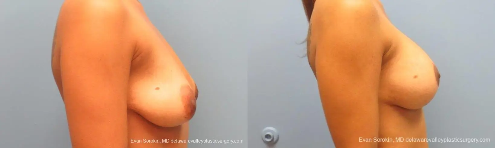 Philadelphia Breast Lift and Augmentation 10119 - Before and After 3