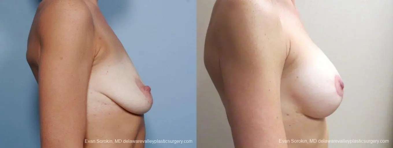 Philadelphia Breast Lift and Augmentation 8683 - Before and After 4