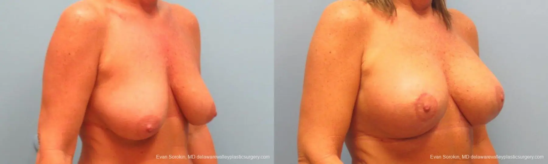 Philadelphia Breast Lift and Augmentation 9398 - Before and After 2