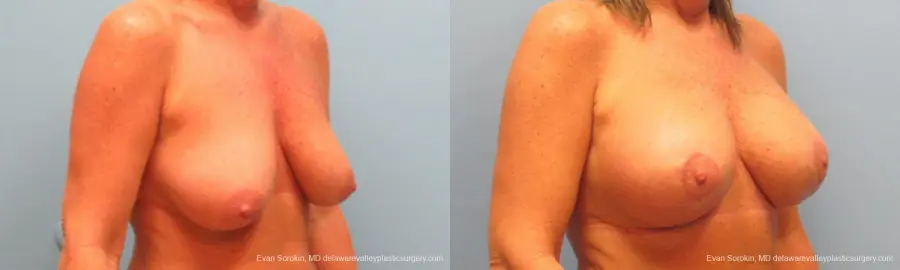 Philadelphia Breast Lift and Augmentation 9398 - Before and After 2