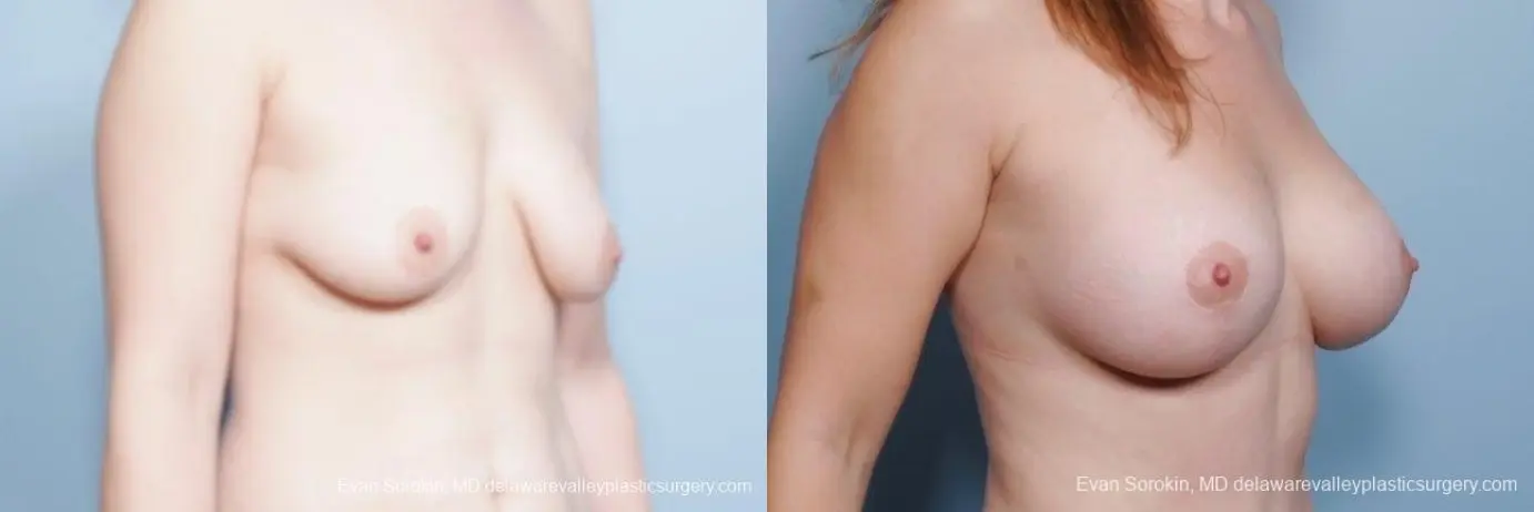 Philadelphia Breast Lift and Augmentation 8680 - Before and After 2