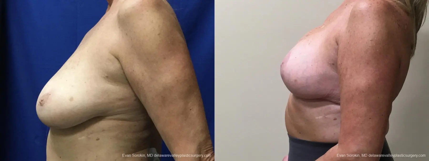 Breast Lift And Augmentation: Patient 49 - Before and After 5