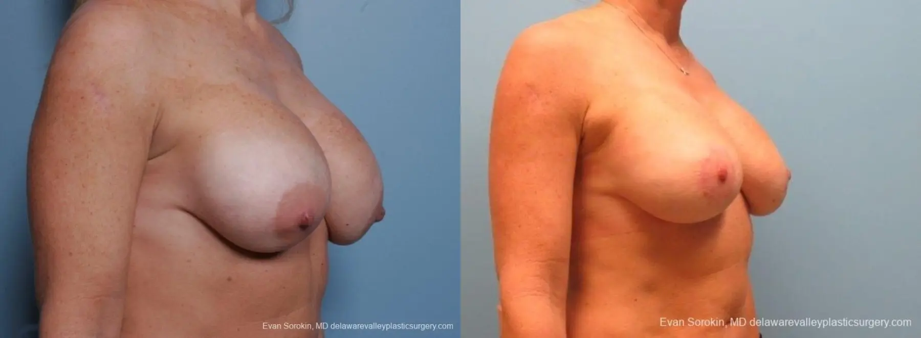 Philadelphia Breast Lift and Augmentation 8690 - Before and After 2