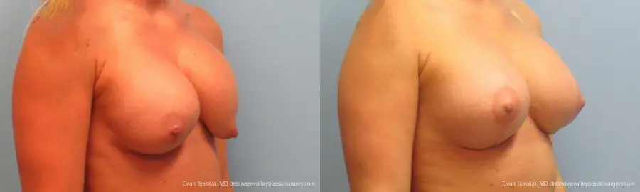 Philadelphia Breast Lift and Augmentation 9370 - Before and After 4