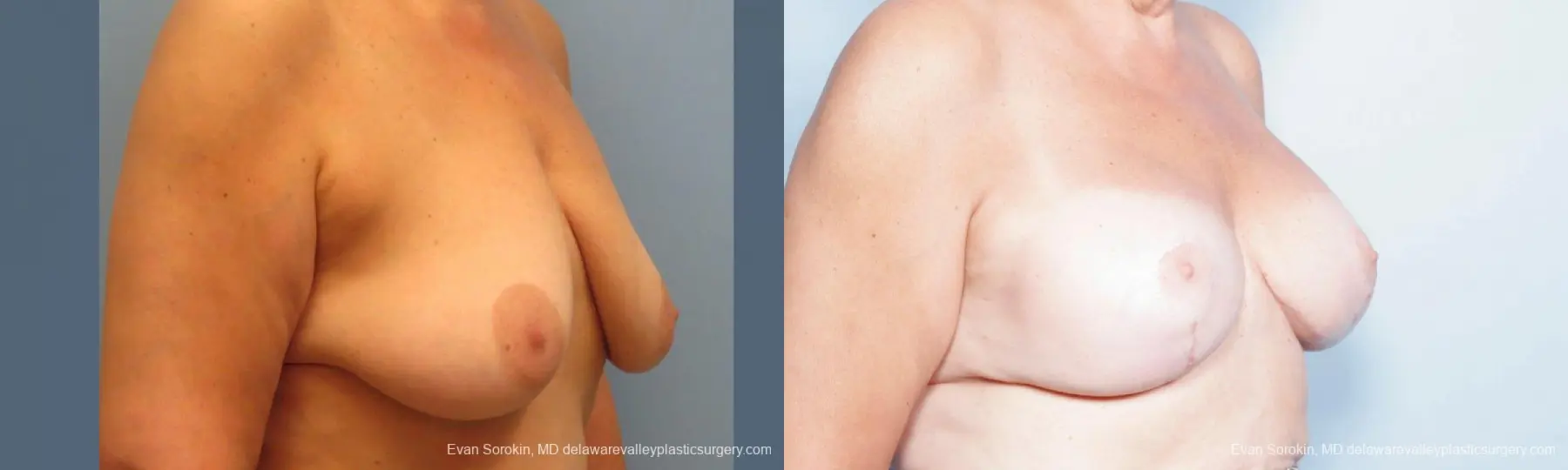 Philadelphia Breast Lift and Augmentation 9431 - Before and After 2