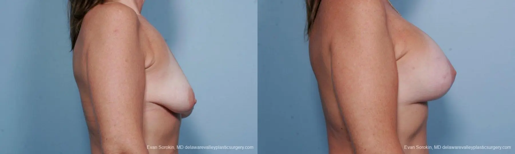 Philadelphia Breast Lift and Augmentation 9438 - Before and After 3