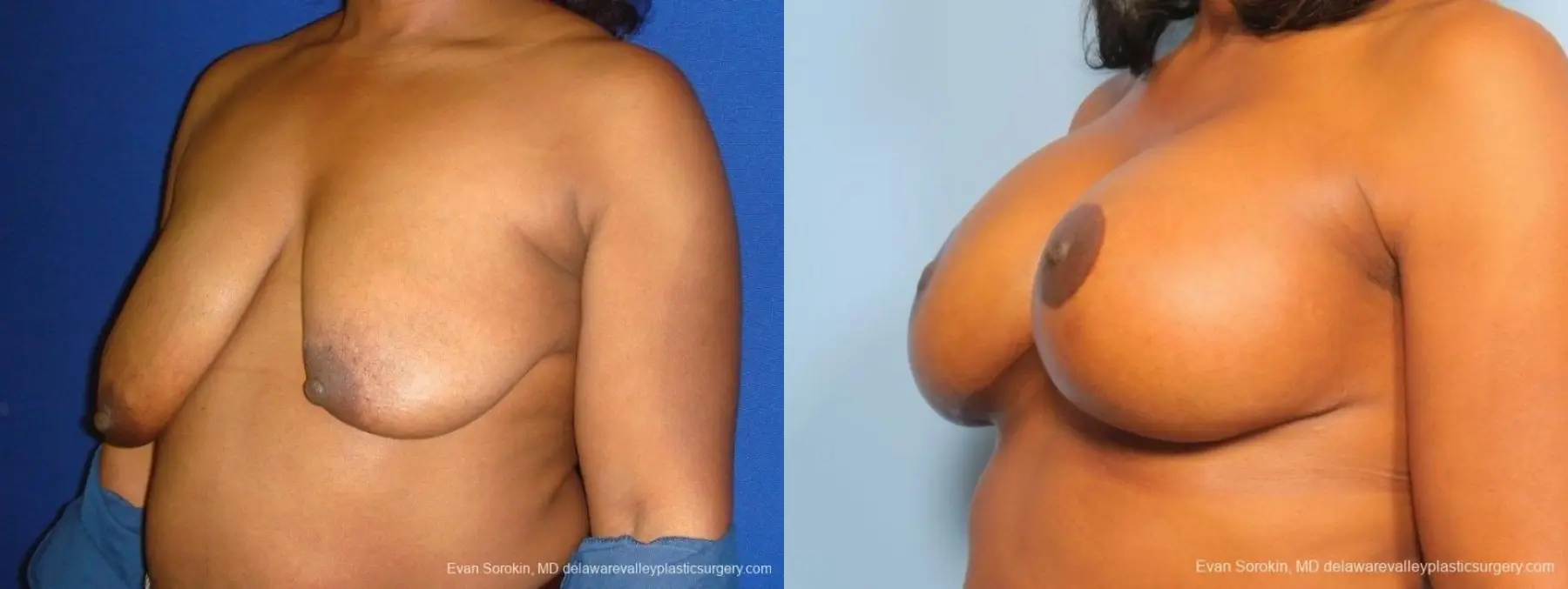 Philadelphia Breast Lift and Augmentation 8684 - Before and After 3