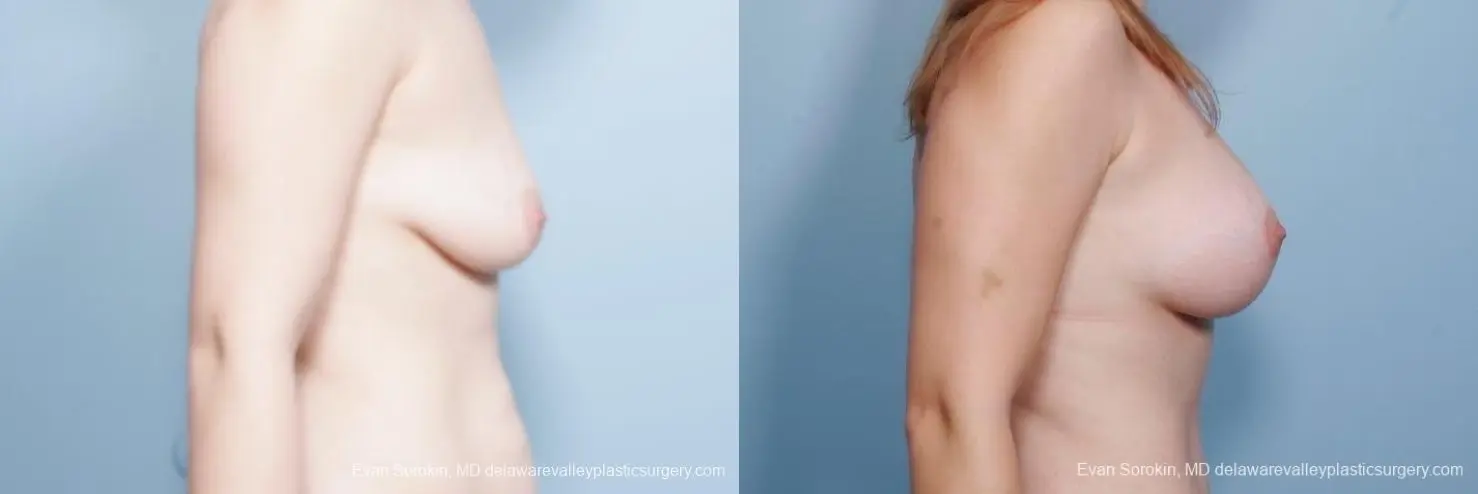 Philadelphia Breast Lift and Augmentation 8680 - Before and After 4