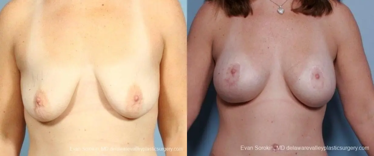 Philadelphia Breast Lift and Augmentation 8675 - Before and After 1