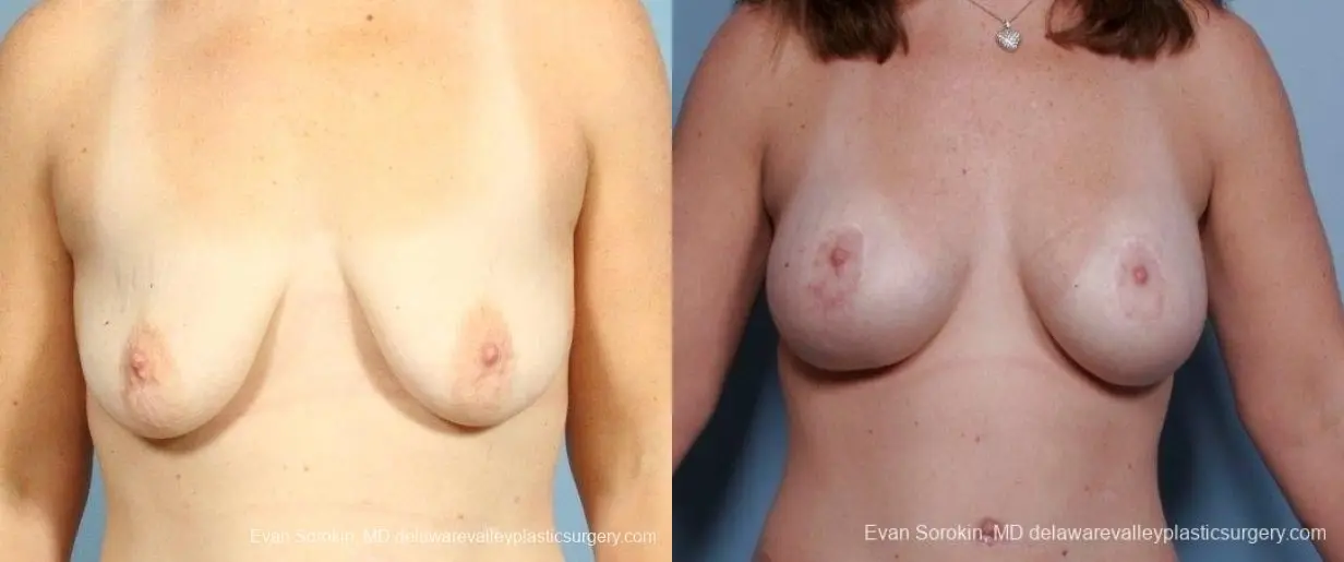 Philadelphia Breast Lift and Augmentation 8675 - Before and After