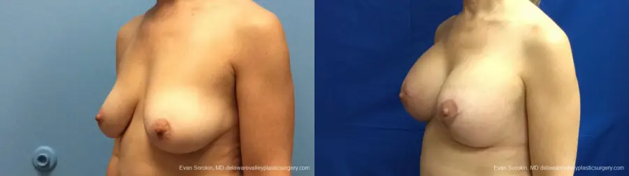 Philadelphia Breast Lift and Augmentation 13179 - Before and After 4