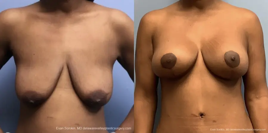 Breast Lift And Augmentation: Patient 45 - Before and After 2
