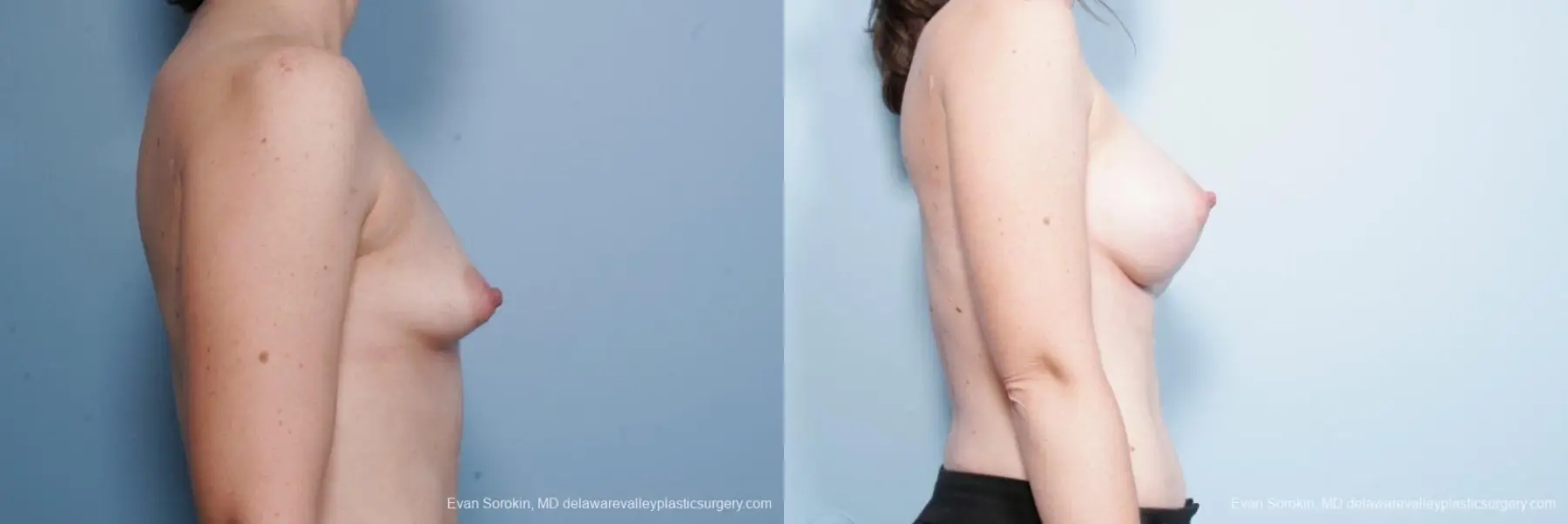 Philadelphia Breast Lift and Augmentation 8686 - Before and After 4