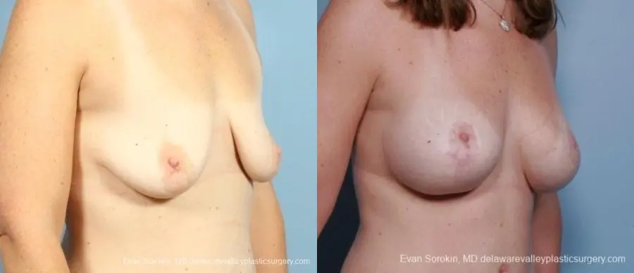 Philadelphia Breast Lift and Augmentation 8675 - Before and After 2
