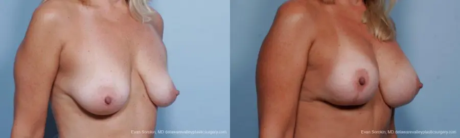 Philadelphia Breast Lift and Augmentation 9375 - Before and After 2