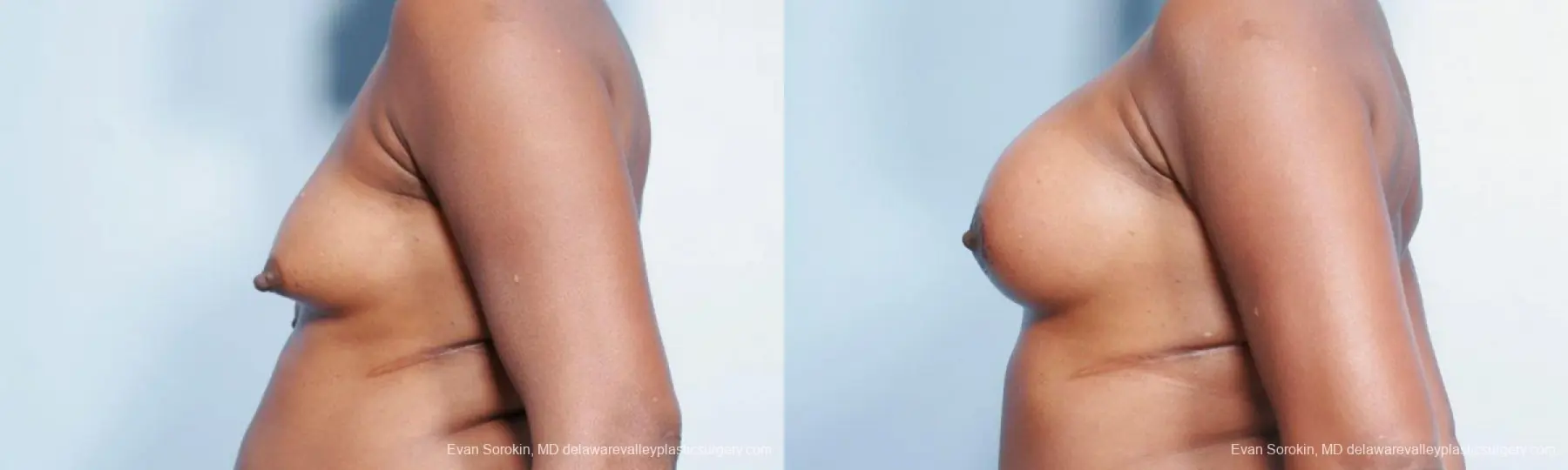 Philadelphia Breast Lift and Augmentation 9427 - Before and After 5