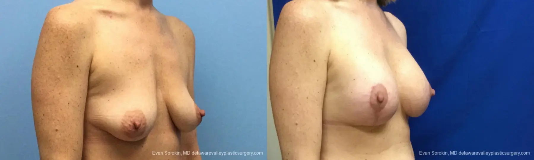 Philadelphia Breast Lift and Augmentation 10814 - Before and After 2