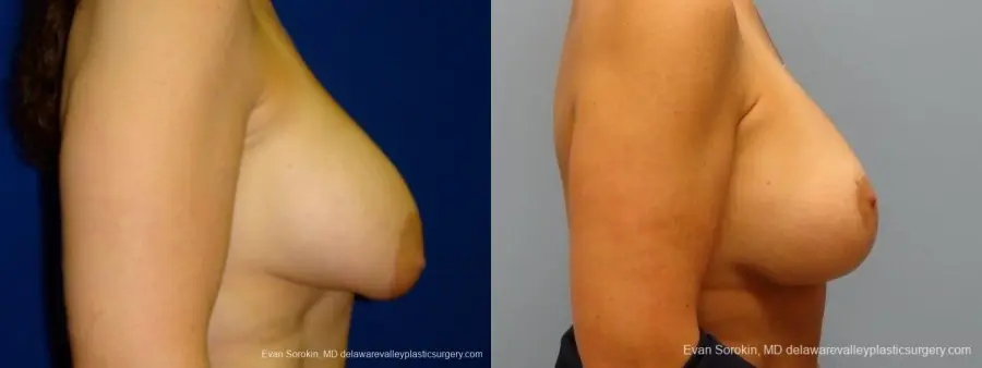 Philadelphia Breast Lift and Augmentation 8696 - Before and After 4