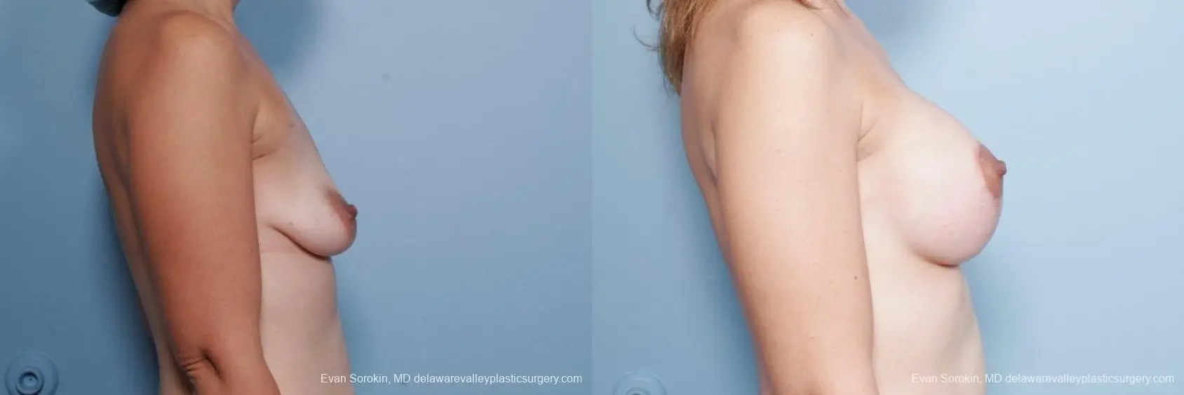 Philadelphia Breast Lift and Augmentation 8685 - Before and After 4