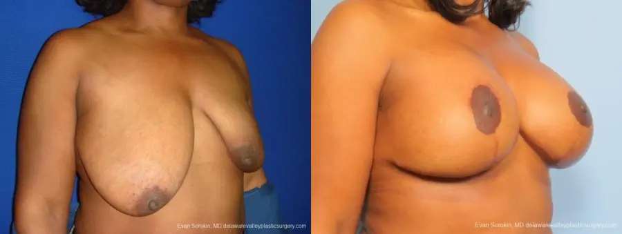 Philadelphia Breast Lift and Augmentation 8684 - Before and After 2