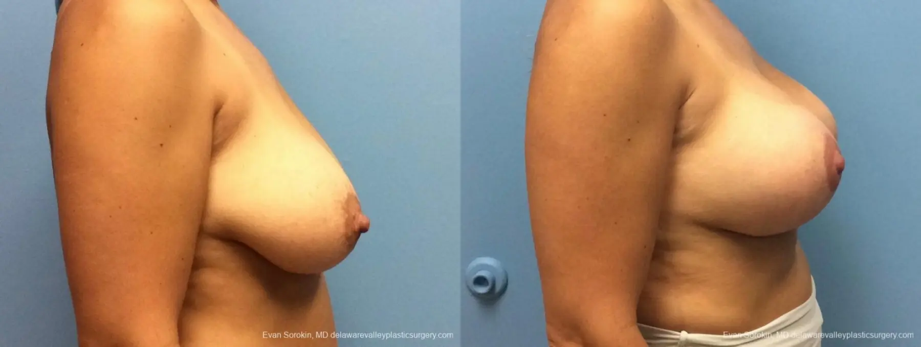 Philadelphia Breast Lift and Augmentation 13070 - Before and After 3