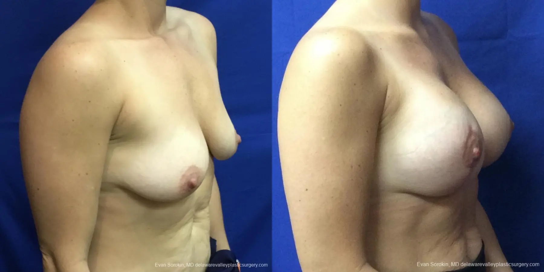 Breast Lift And Augmentation: Patient 3 - Before and After 2