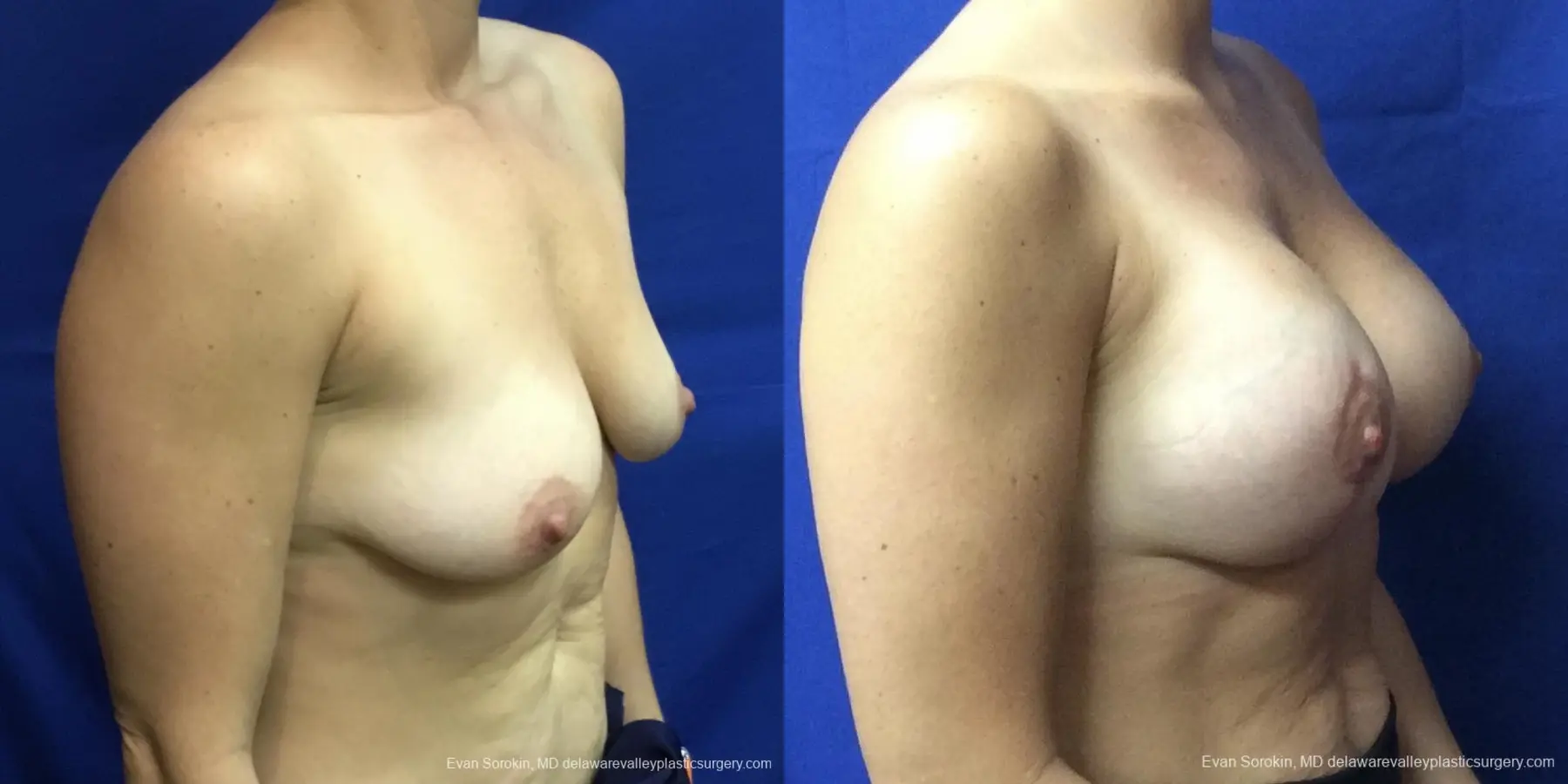 Breast Lift And Augmentation: Patient 4 - Before and After 2