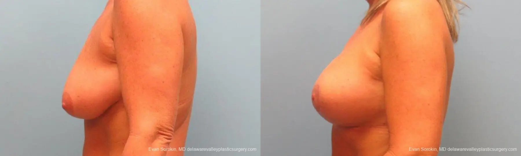 Philadelphia Breast Lift and Augmentation 9398 - Before and After 5