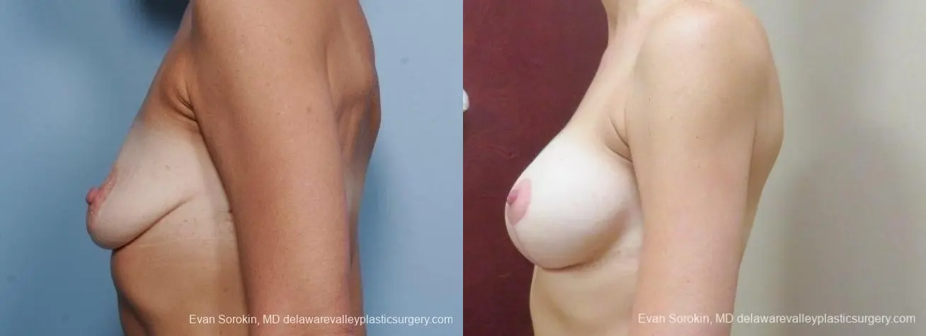 Philadelphia Breast Lift and Augmentation 8683 - Before and After 5